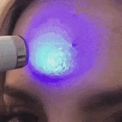 Bolígrafo luz azul removedor de acné